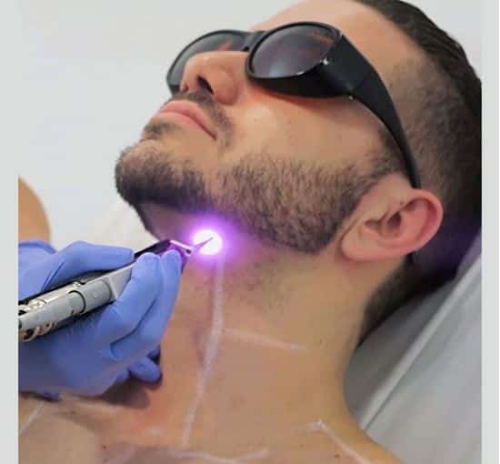 laser hair removal for man