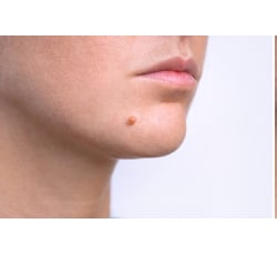 TCA50%-Warts Removal