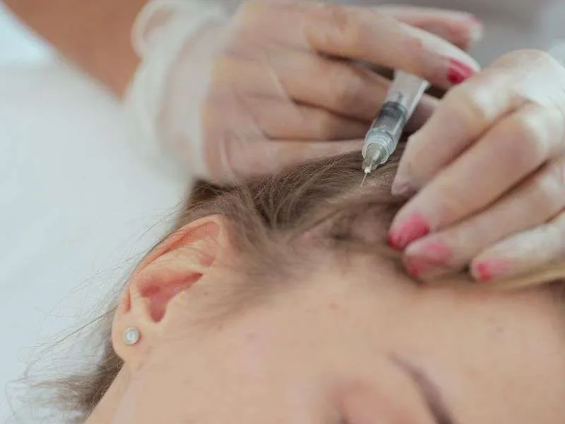 exosomes-hair-loss-therapy